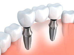 dental-implants-graphic